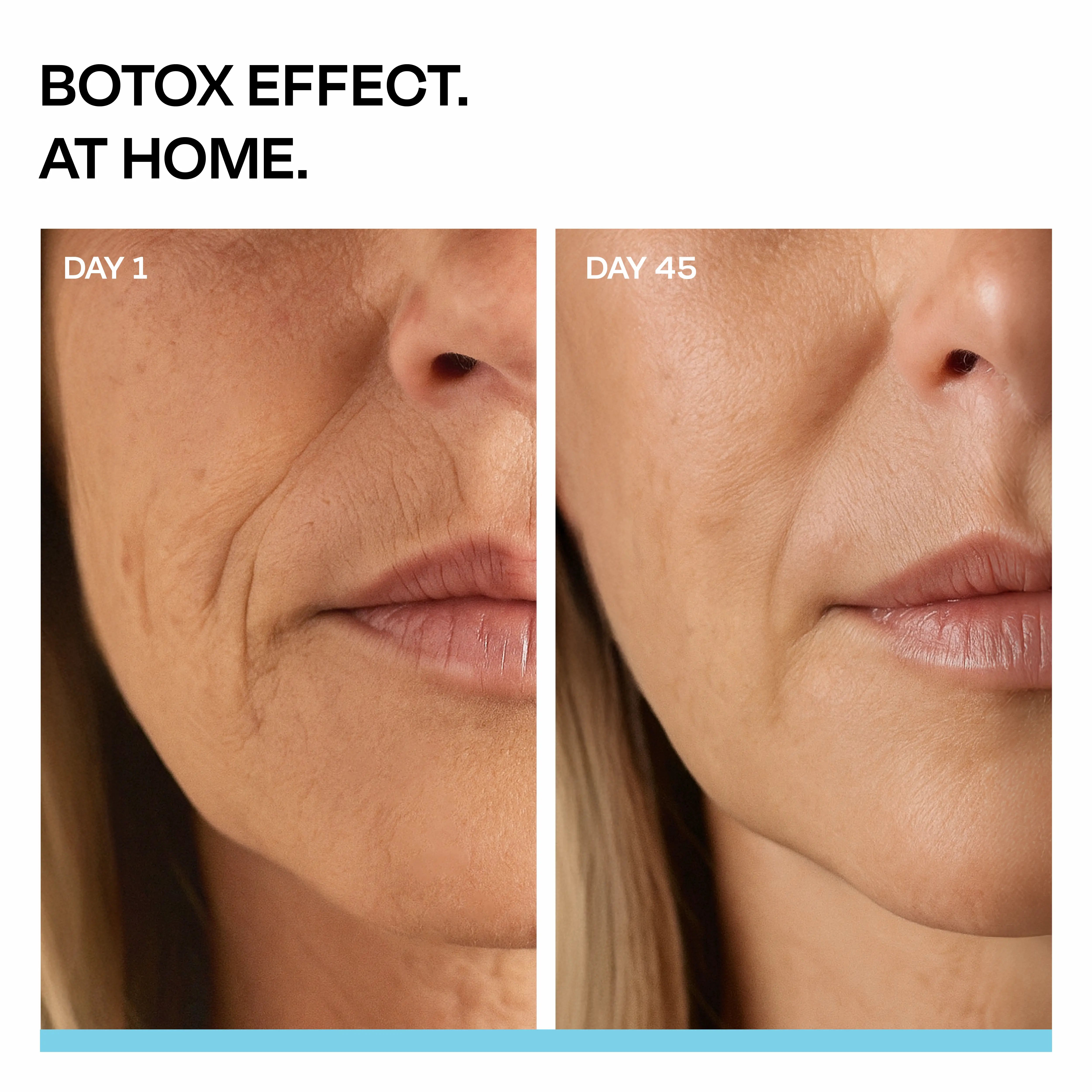 Triple Action Microinfusion