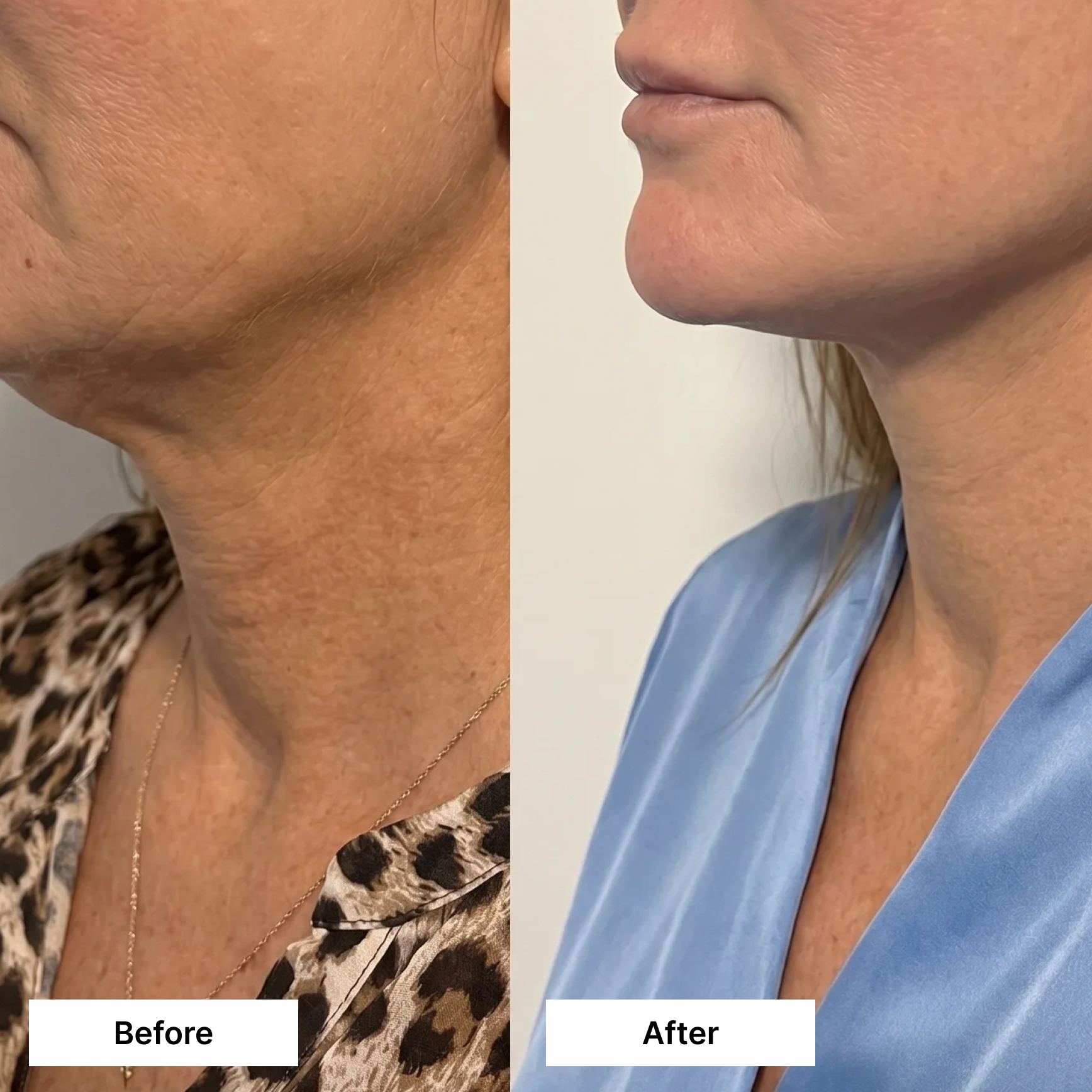 Dual Action Lifting Cream