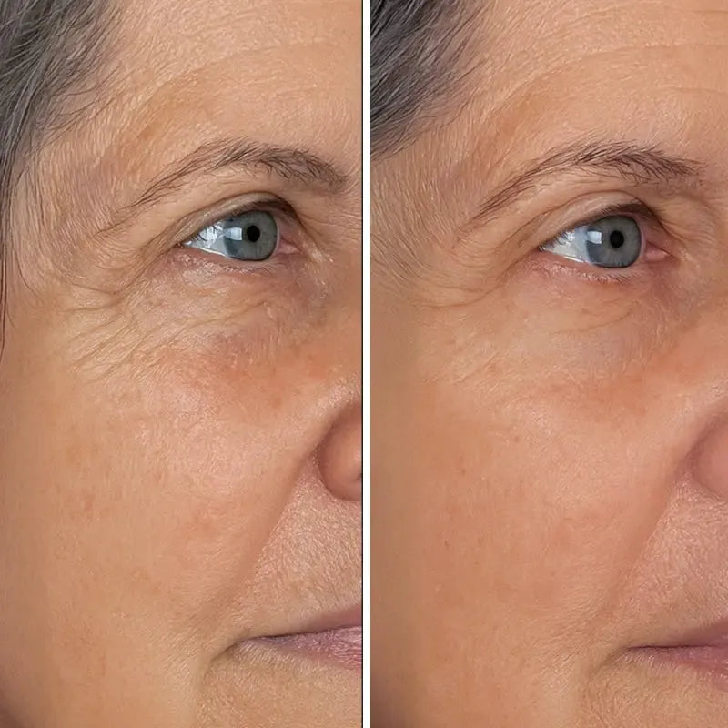 okoa-crows-feet-before-after.webp