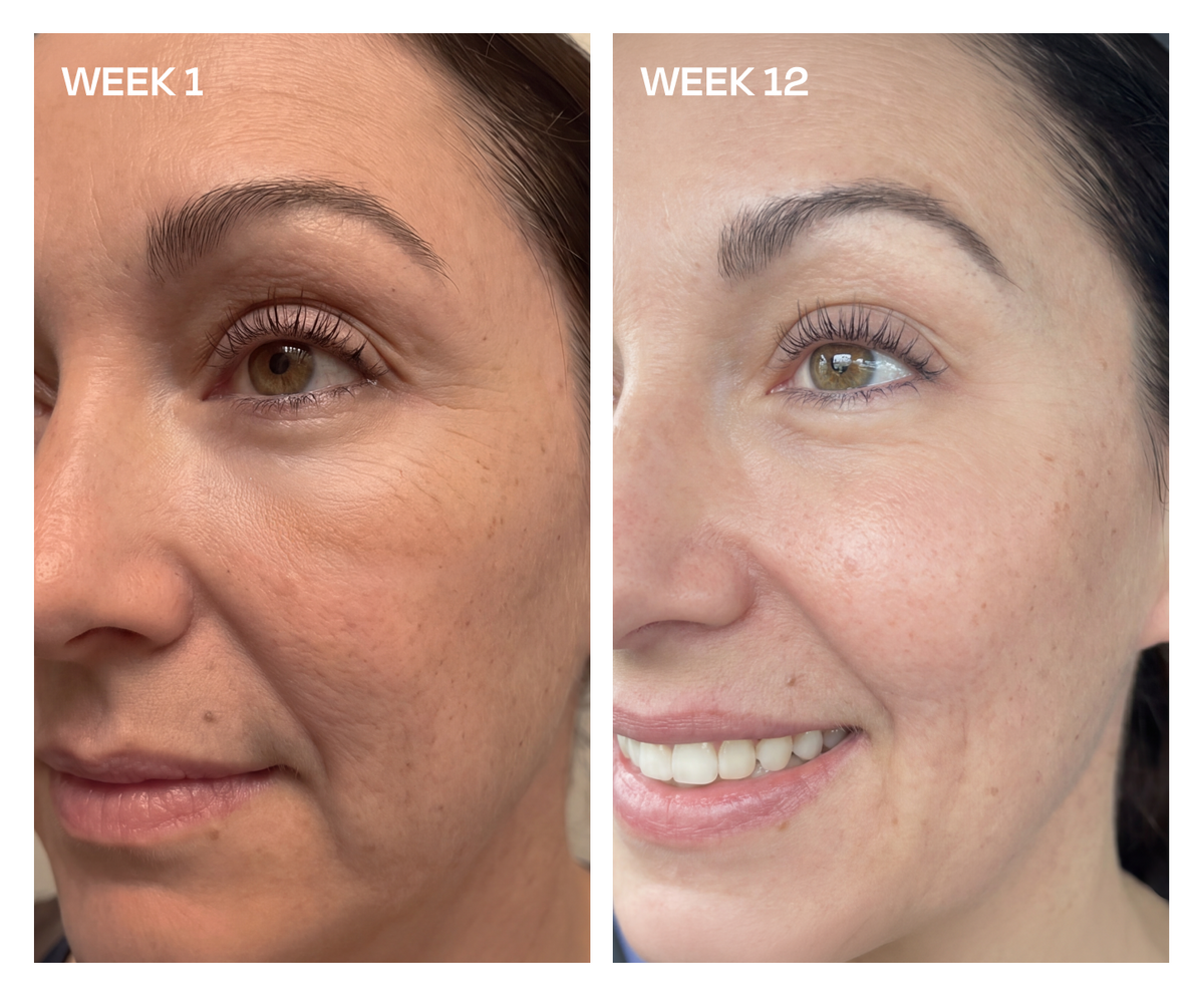 what is retinol in skincare