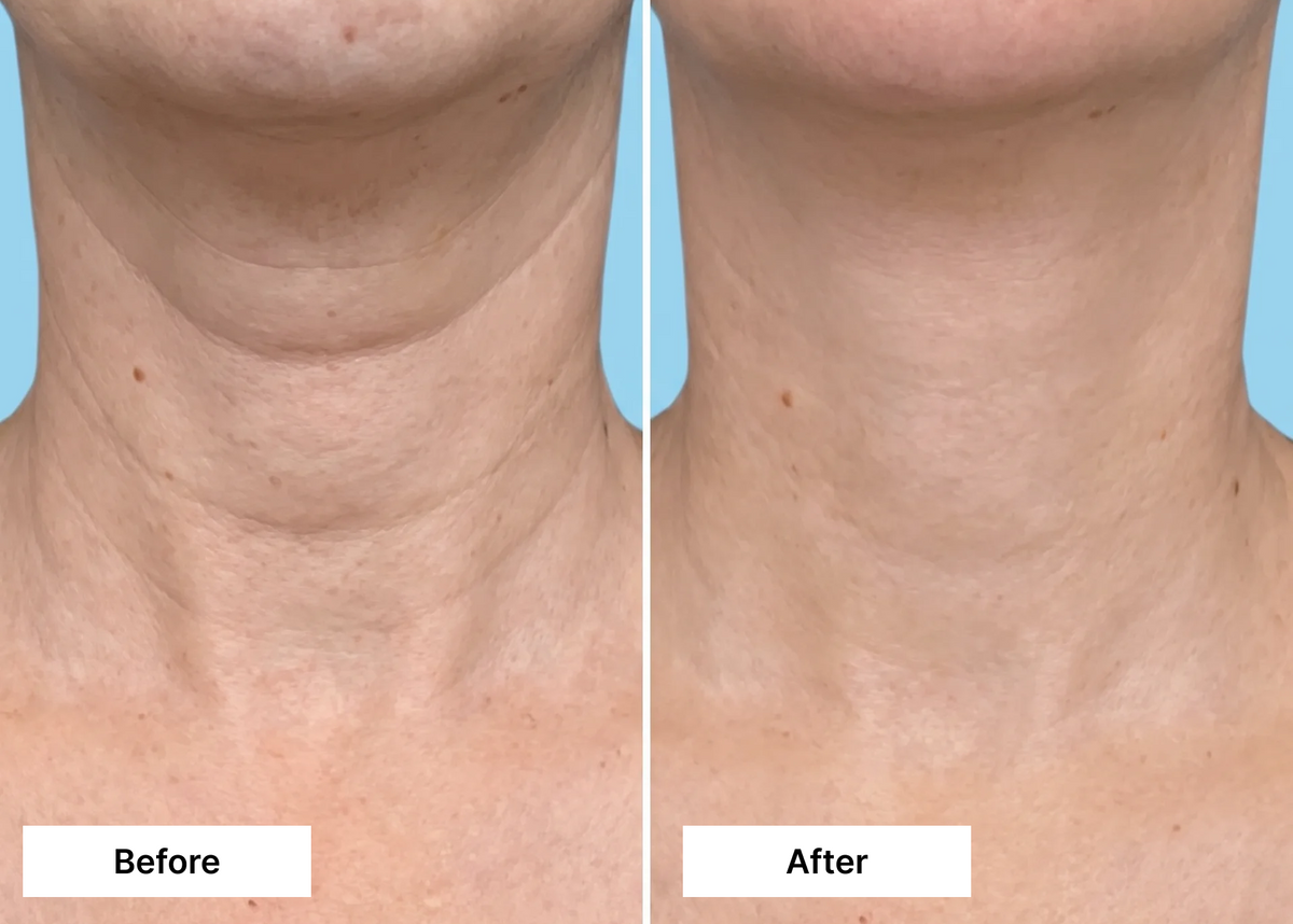 Before and after: a visibly firmer, smoother-looking neck with OKOA Dual Action Lifting Cream